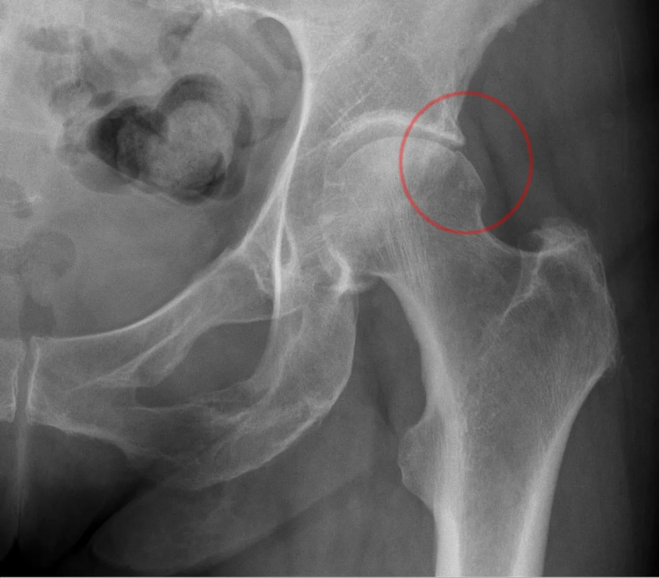 Femoroasetabular Sıkışma (Kalça Sıkışması)