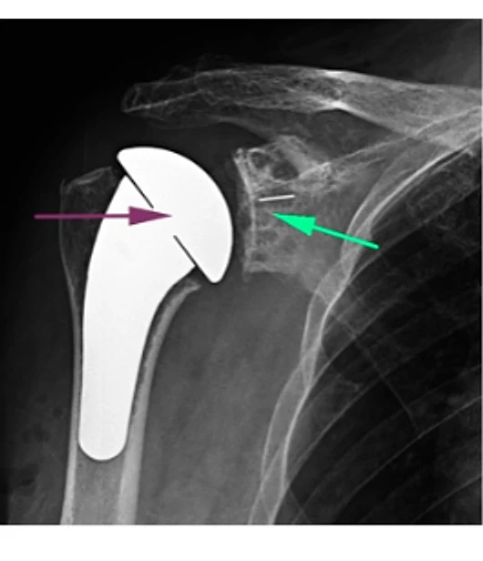 Shoulder Replacement