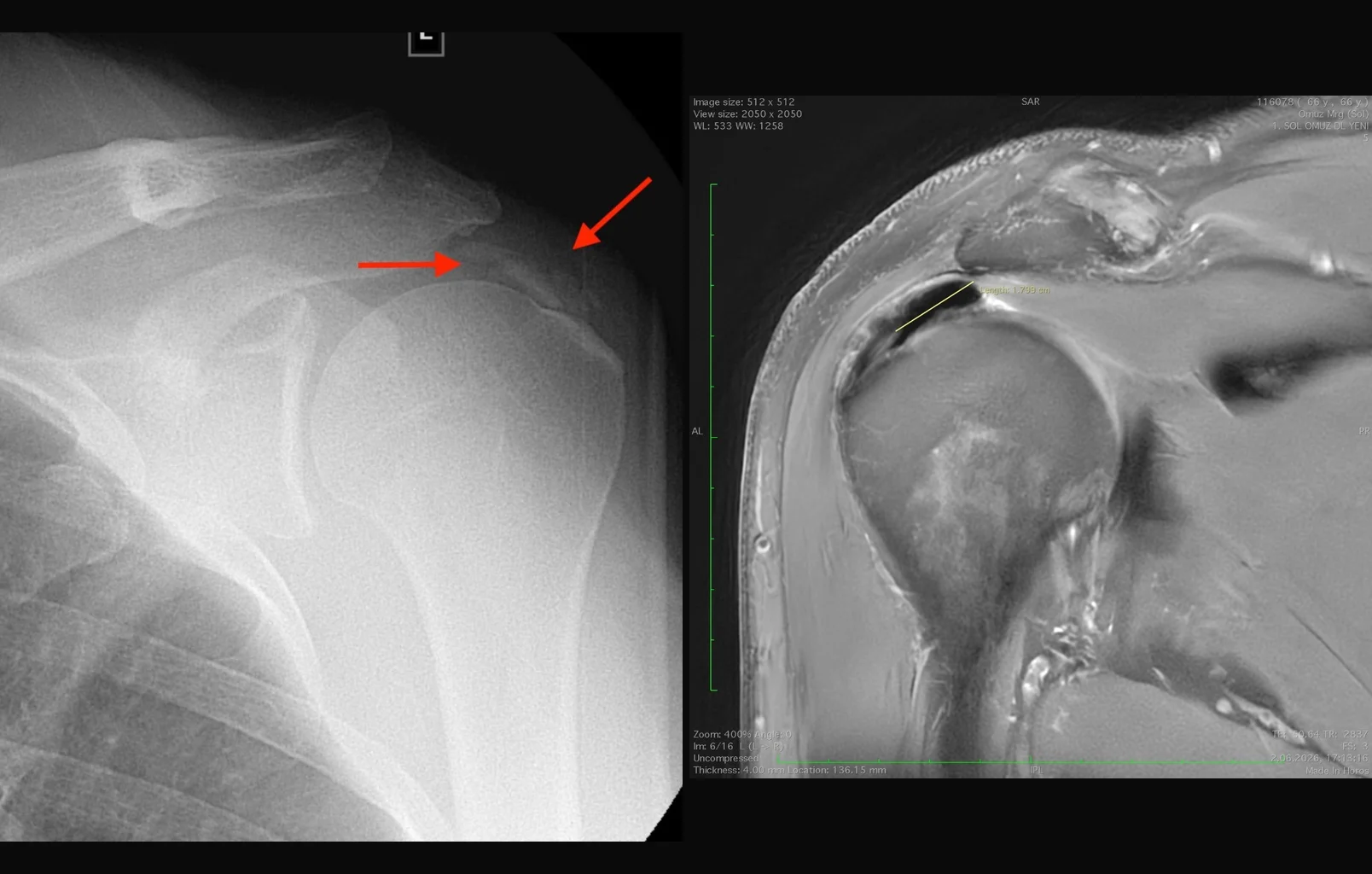 Treatment of Calcific Tendinitis of the Shoulder: A Permanent Solution with the Barbotage Method