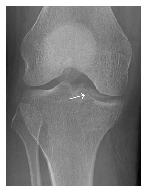 Tibia sinishlari