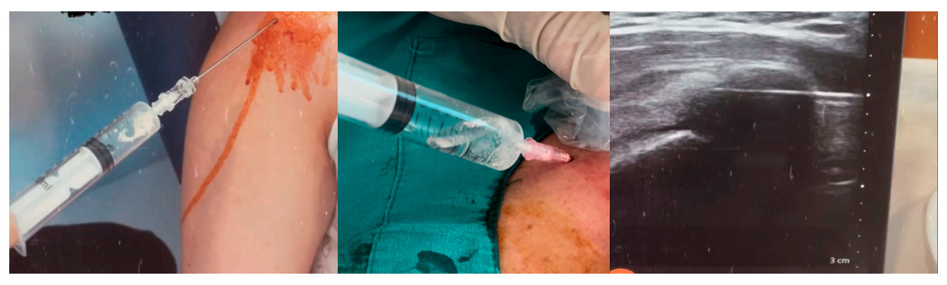 Ameliyatsız ve Etkili Bir Yöntem: Barbotaj