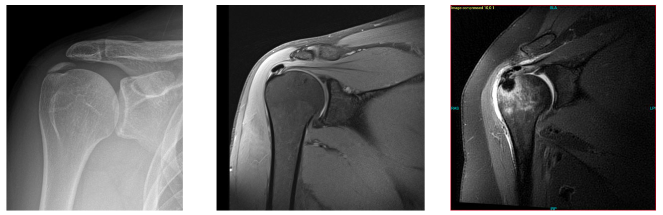 Kalsifik Tendinit Nedir