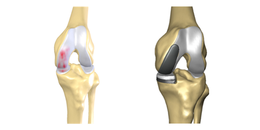 Unikondiler Diz Protezi