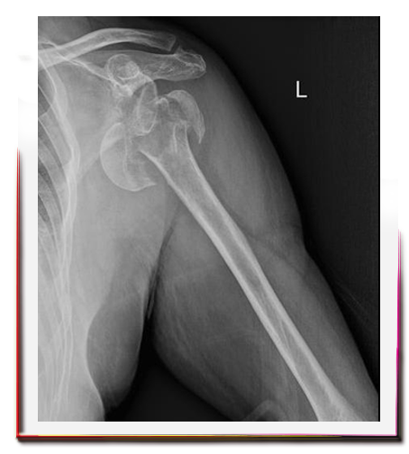 Omuz Kırıklı Çıkığı