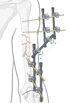 Parçalı Kol Kırığı Çivi Ameliyatı