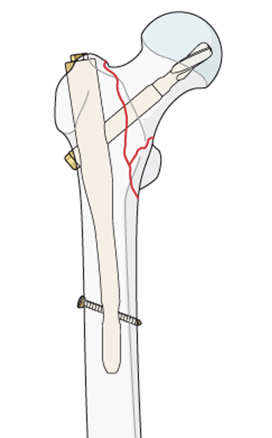 Minimal İnvaziv Kalça Cerrahisi
