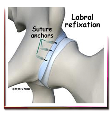 Kalça Labrum Tamiri