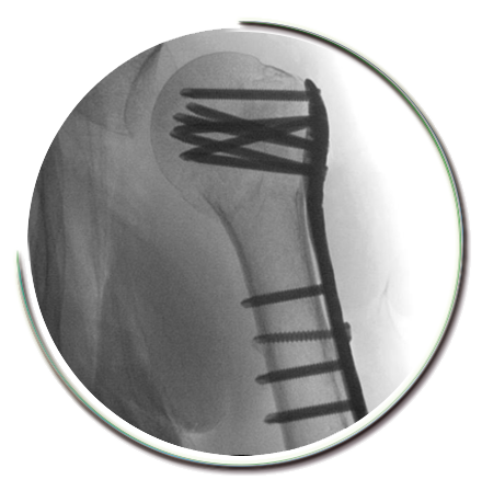 Omuz kırığı ameliyatı