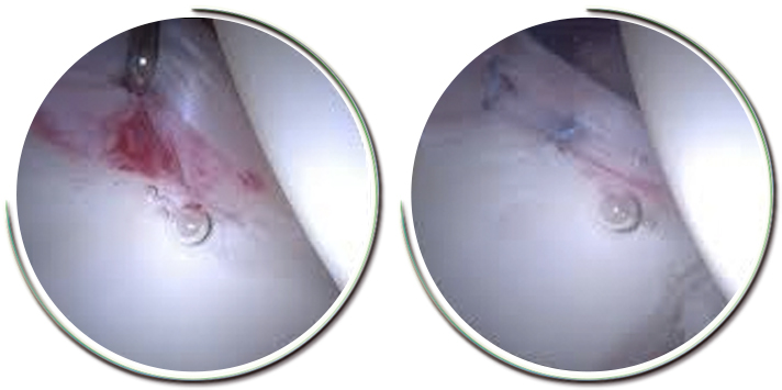 Artroskopik Kalça Ameliyatı