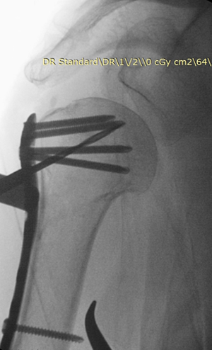 Minimal invaziv plak omuz