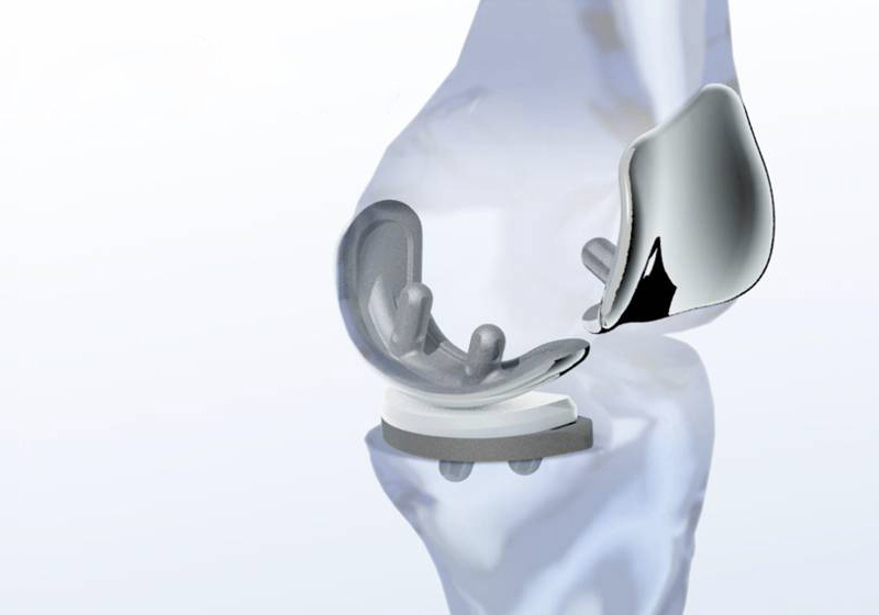 Unikondiler diz protezi, makoplasty, robotik diz cerrahisi, diz cerrahisi, diz protezi