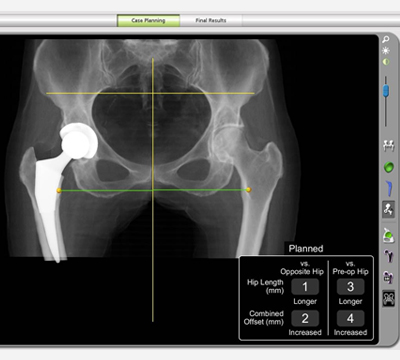 Makoplasty, robotik cerrahi, kalça protezi, kalça kireçlenmesi, protez ameliyatı