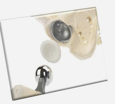 Kalça protezi, kalça kireçlenmesi, protez ameliyatı