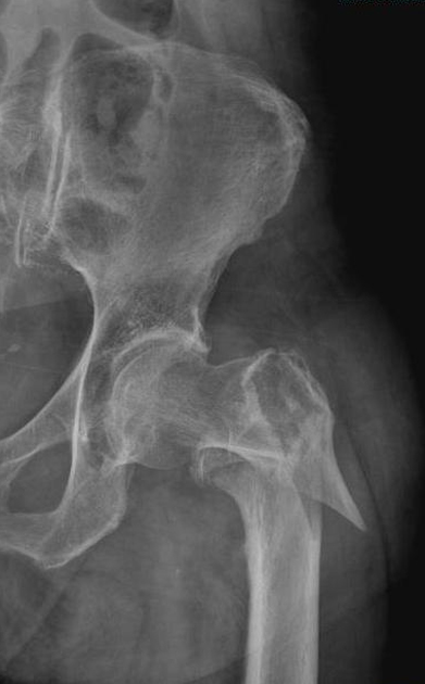 Minimal İnvaziv Kalça Cerrahisi