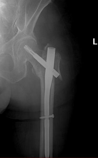 Minimal İnvaziv Kalça Cerrahisi