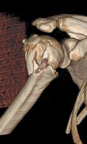 Parçalı Omuz Kırığı