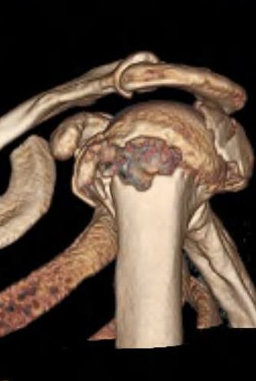 Parçalı Omuz Kırığı