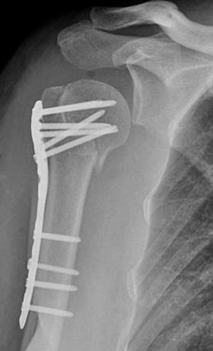 Omuz Kırığı Ameliyatı