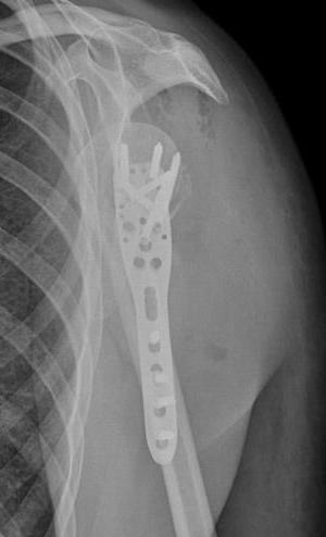 Omuz Kırığı MİPO Ameliyatı