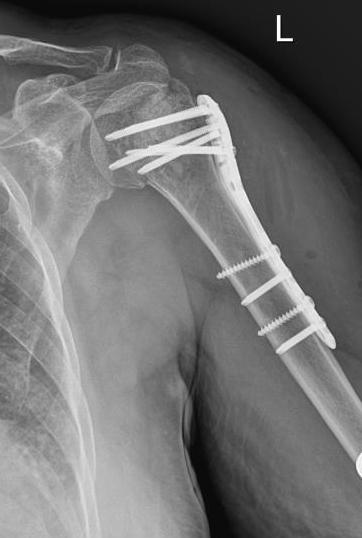 Omuz Kırığı Ameliyatı