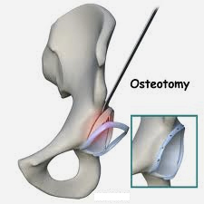 Femoroasetabular sıkışma