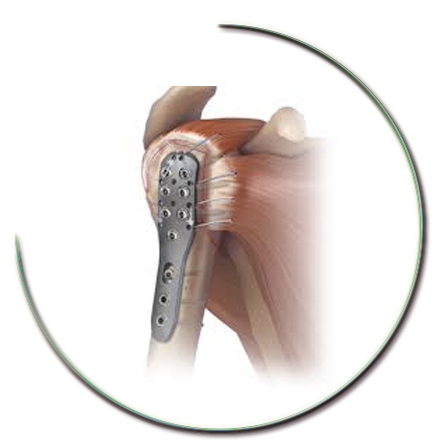 Omuz kırığı ameliyatı