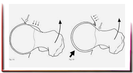 Femoroasetabular sıkışma