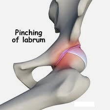 Kalça Sıkışması