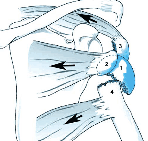 Parçalı Omuz Kırığı