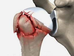 Parçalı omuz kırığı