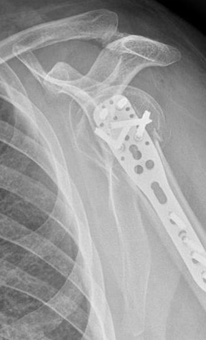 Plak vida ameliyatı omuz