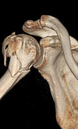 Parçalı omuz kırığı