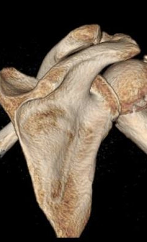 Parçalı Omuz Kırığı