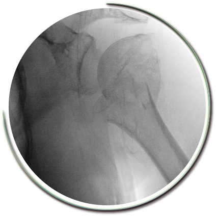 Parçalı Omuz Kırığı