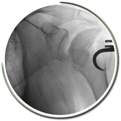 Parçalı Omuz Kırığı Ameliyatı