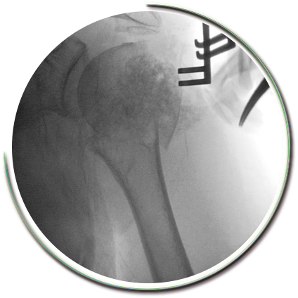 Parçalı Omuz Kırığı Ameliyatı