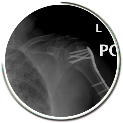 Parçalı Omuz Kırığı Plak Vida Ameliyatı