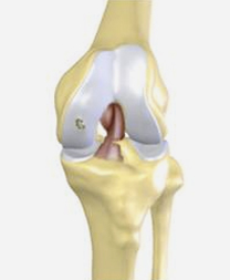 Diz kireçlenmesi, gonartroz, protez ameliyatı, diz protezi, yapay eklem