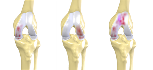 Makoplasty, unikondiler, Diz kireçlenmesi, gonartroz, protez ameliyatı, diz protezi, yapay eklem