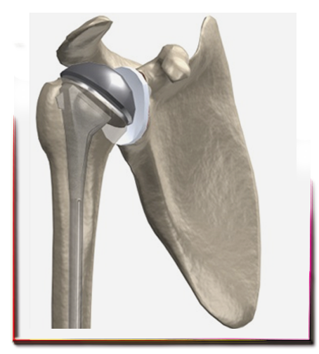 Omuz protezi ameliyatı