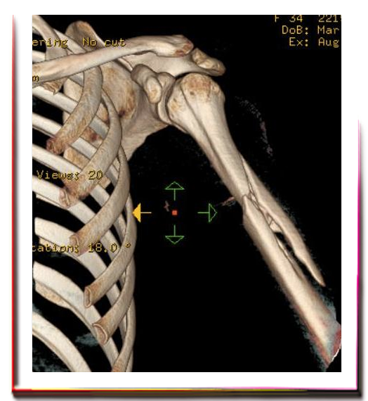 Parçalı Kol Kırığı