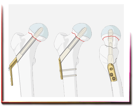 Kalça Kırığı Ameliyatı