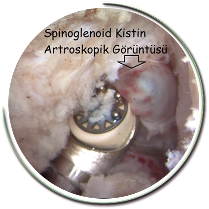 Spinoglenoid Kist Ameliyatı