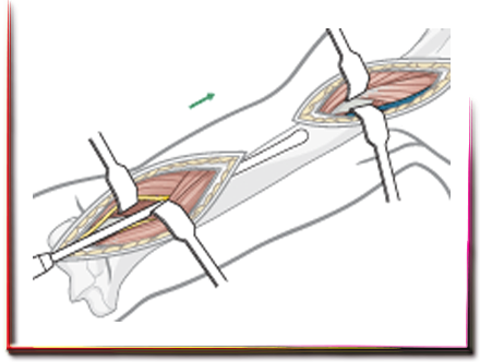 Minimal İnvaziv Kırık Cerrahisi