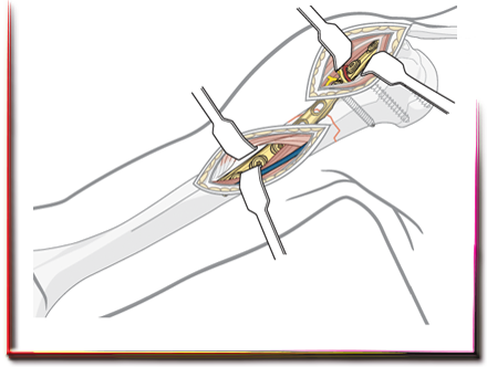 Minimal İnvaziv Kırık Cerrahisi