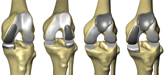 Makoplasty, unikondiler, Diz kireçlenmesi, gonartroz, protez ameliyatı, diz protezi, yapay eklem