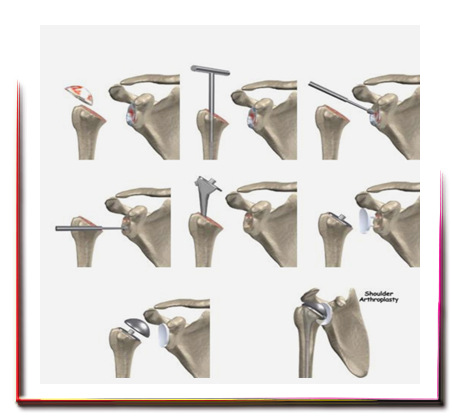 Omuz Protezi