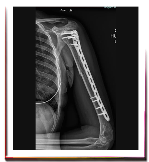 Parçalı Kol Kırığı Ameliyatı