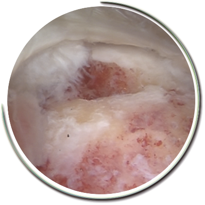 Rotator Manşet yırtığı