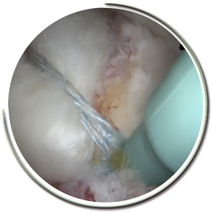 Rotator Manşet yırtığı